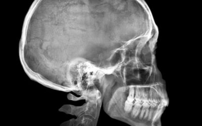 La recuperación de un traumatismo craneoencefálico
