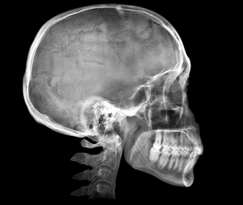 La recuperación de un traumatismo craneoencefálico