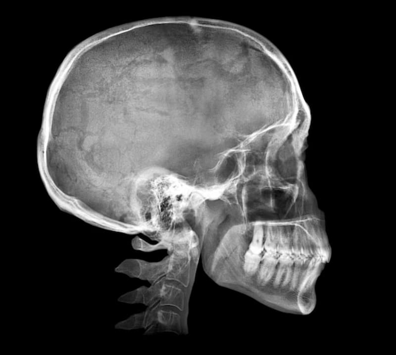 La recuperación de un traumatismo craneoencefálico