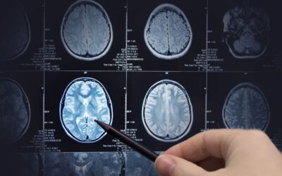 Ictus Isquémico Secuelas y tratamiento con fisioterapia