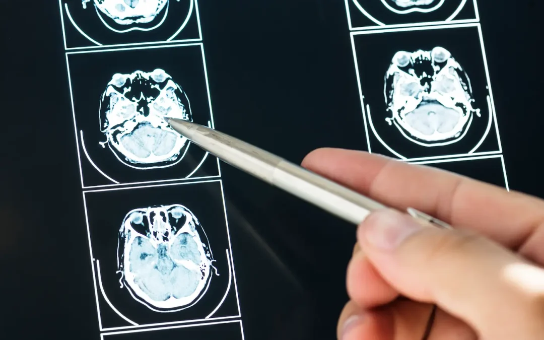 Anoxia cerebral: qué es, causas y cómo afecta al cerebro