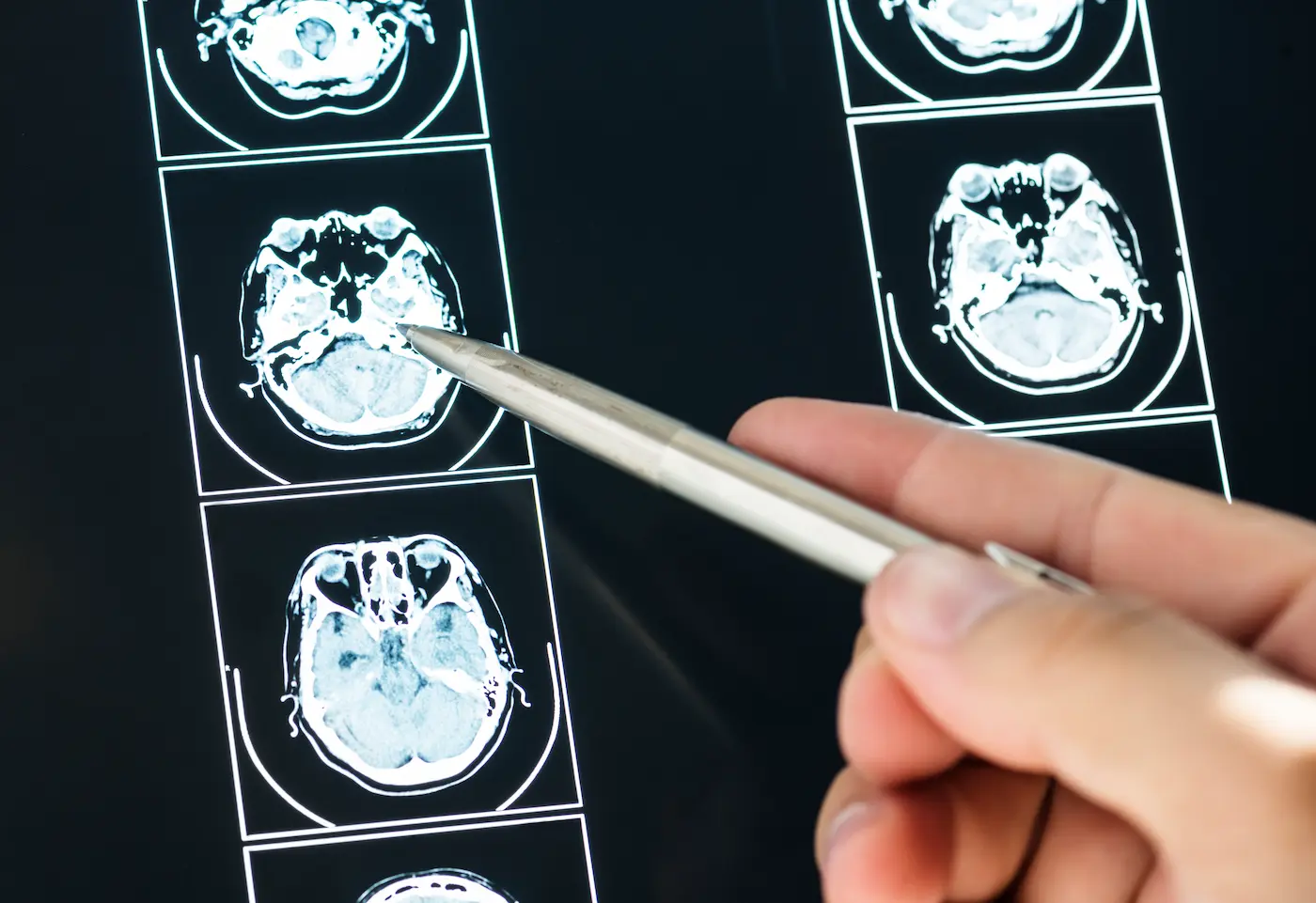 anoxia cerebral